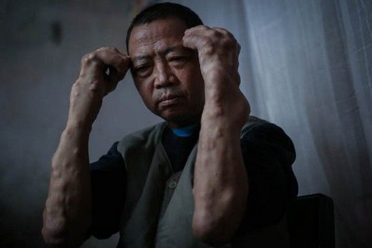 镉中毒会使人的骨骼生长代谢受阻碍，从而造成骨骼疏松、萎缩、变形等。